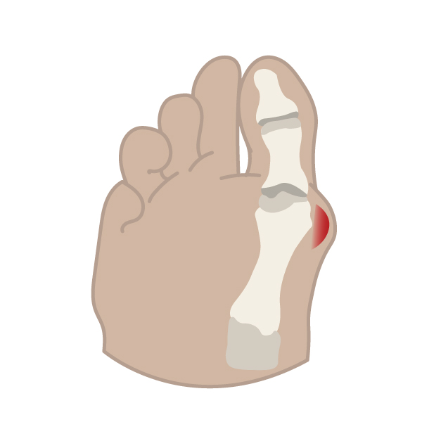 Custom-Brand-Illustration_Paris-everyBODY_Diagrams_Bunions