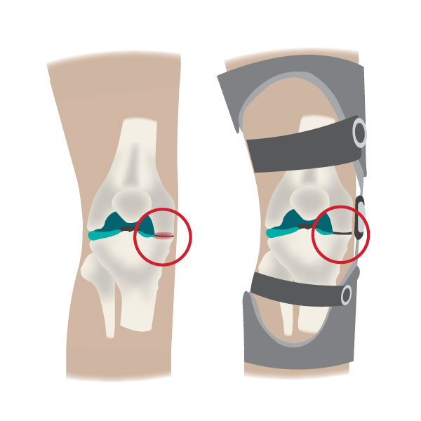 Custom-Brand-Illustration_Paris-everyBODY_Diagrams_Osteoarthritis-Brace