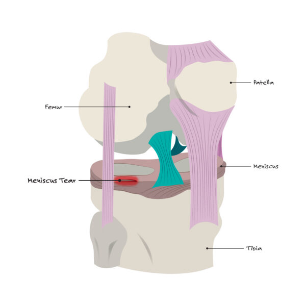 Meniscus Tear